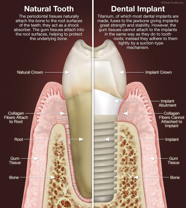 dental-implant-vs-natural-tooth